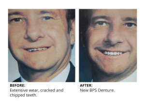 Island Dentures high quality BPS dentures.
