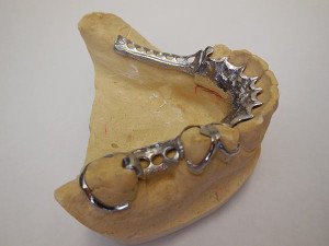 Island Dentures provides high quality partial dentures.